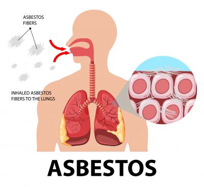 Health Impact of Asbestoses
